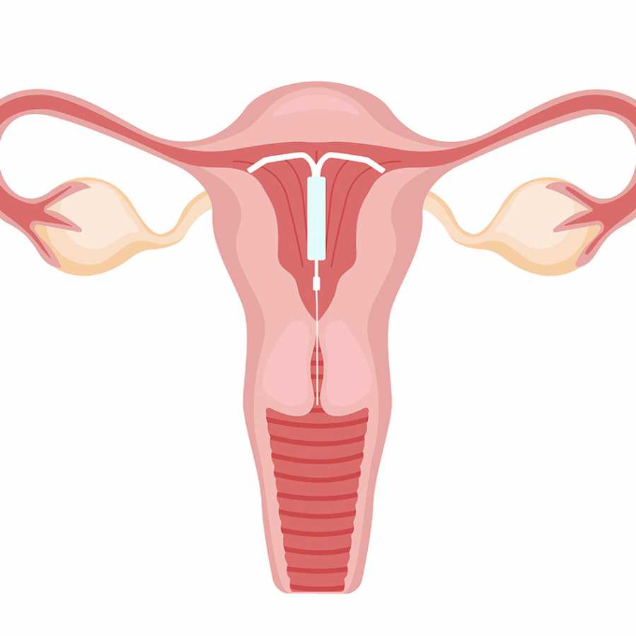Onde Colocar DIU em SP? Diu de Cobre, Prata ou Diu Hormonal